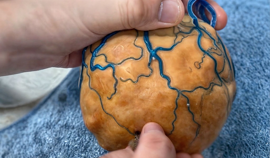 zone3Dplus 3D Printed Tumor Vessel Model